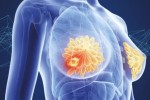 2022年的ASCO在乳腺癌领域最值得期待的研究非DESTINY-Breast04莫属